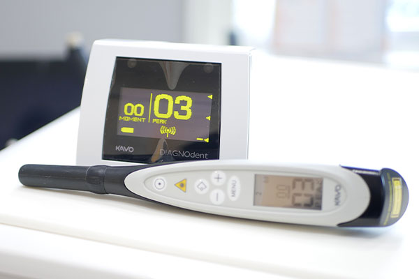 レーザー測定器で初期むし歯をしっかり管理！